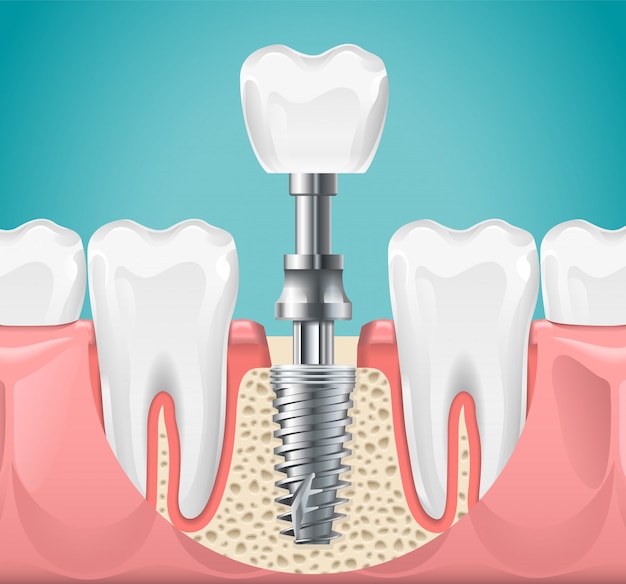 dental-implants