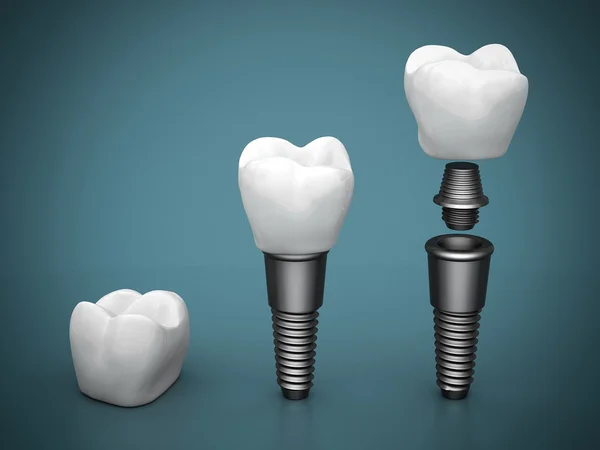 dental-implants