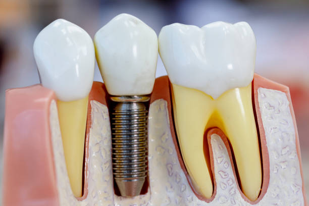 dental-implants