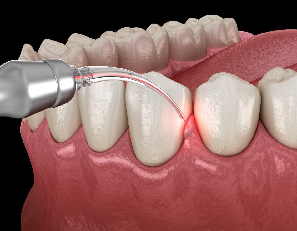 periodontal-therapy