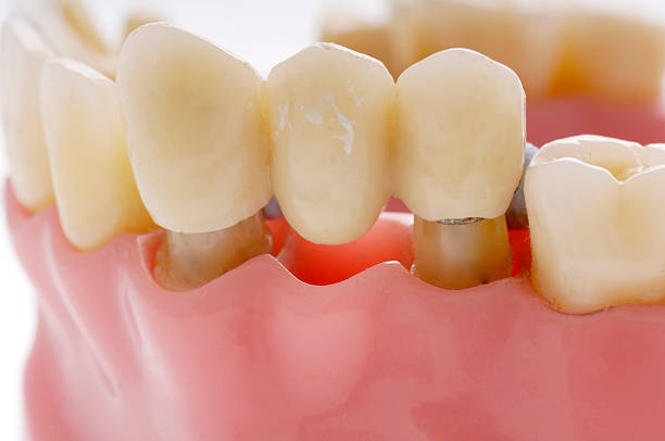 Dental-Crowns-and -Bridges