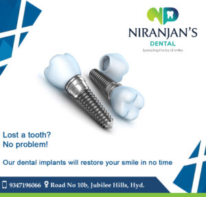 Read more about the article Best Dental Implant Clinic in Jubilee Hills