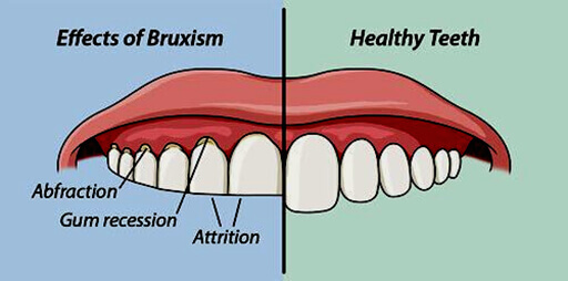 full-mouth-rehabilitation