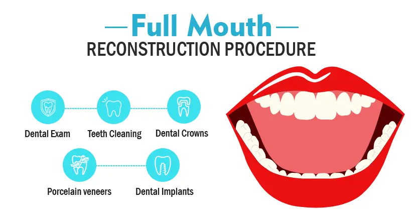 full-mouth-rehabilitation