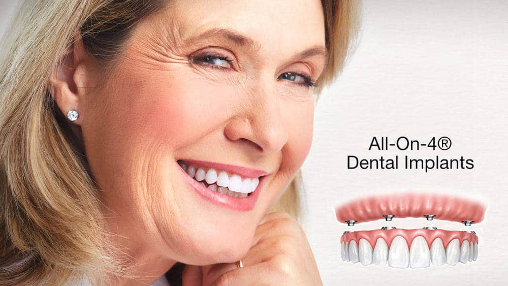 Read more about the article How Long Do All On 4 Dental Implants Take