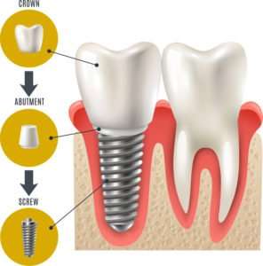 Read more about the article Dental Implants in Jubilee Hills