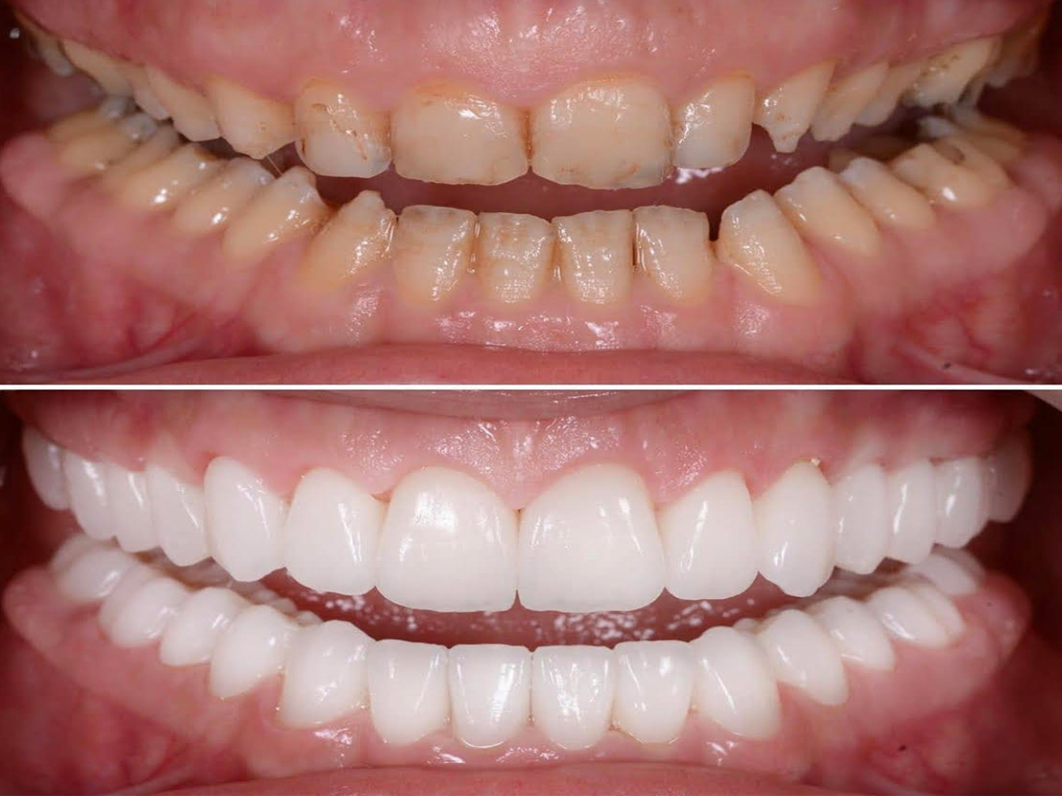 Read more about the article Full Mouth Reconstruction in Jubilee Hills