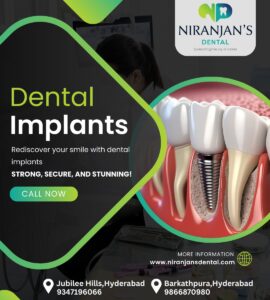 Read more about the article All On 4 Dental Implants Procedure