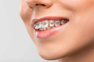 Read more about the article Best Orthodontic Braces Clinic in Jubilee Hills Hyderabad